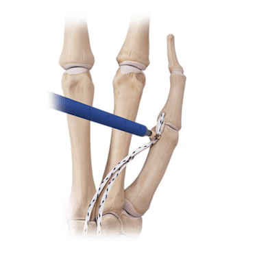 <em>Internal</em>Brace™-Implantatekit zur Bandaugmentation an Hand/Handgelenk