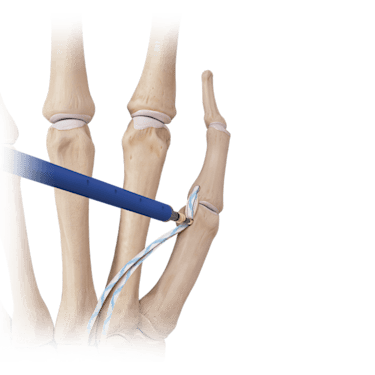 Hand/Wrist <em>Internal</em>Brace™ Ligament Augmentation Repair