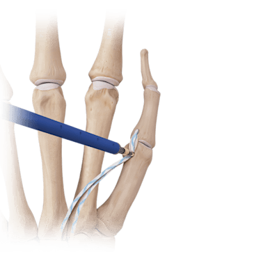 Aumentación en la reparación de ligamentos de mano y muñeca con <em>Internal</em>Brace™