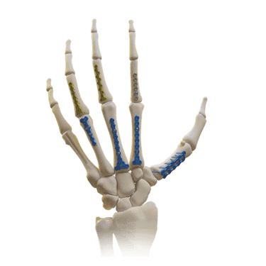 Umfassendes Mini-Fixierungssystem (Hand und Handgelenk)