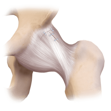 LoopLoc™ Knotenloses Implantat