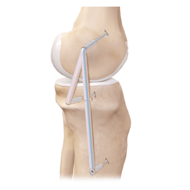 Medial Collateral Ligament (MCL) Reconstruction