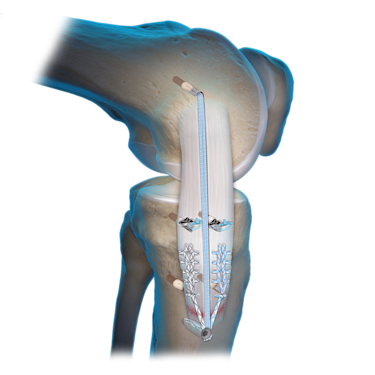 Medial Collateral Ligament (MCL) Repair 