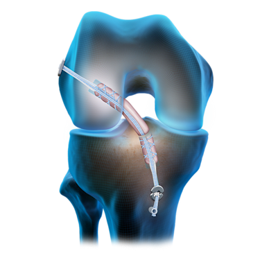 Reconstrucción del LCA con injerto de tendón del cuádriceps