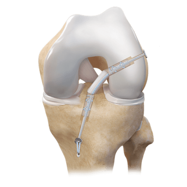 Reconstrução do LCA com enxerto do tendão quadricipital
