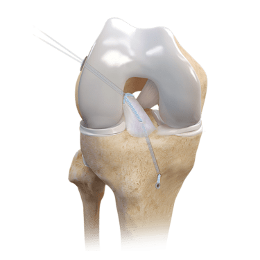 ACL Repair TightRope® Implant With FiberRing™ Sutures