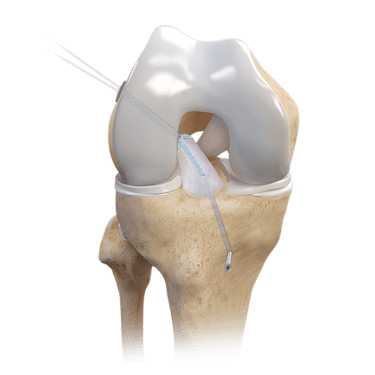 Repair TightRope® Implant With FiberRing™ Sutures