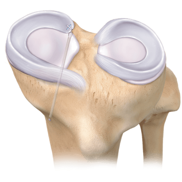 Reparación de raíz meniscal