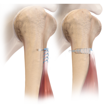 FiberTak<sup>®</sup> Button Tenodesis Technique