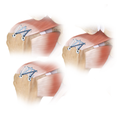 FiberTak® SpeedBridge™ Rotator Cuff Repair