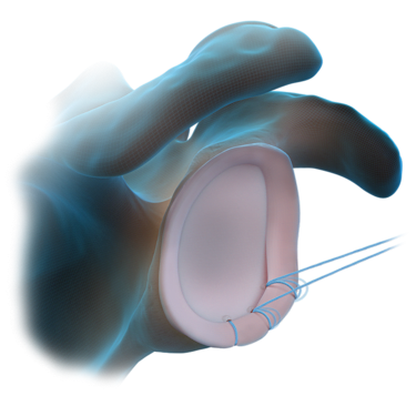 Técnica com âncora FiberTak<sup>®</sup> sem nós para tecidos moles