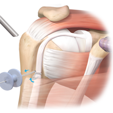 Knotless TensionTight™ Tenodesis Technique