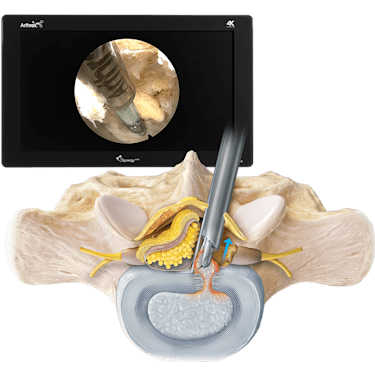Interlaminar Endoscopic Discectomy