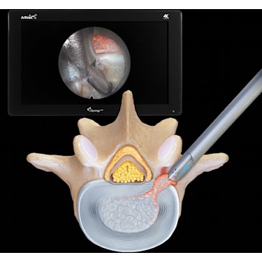 Transforaminal Endoscopic Discectomy