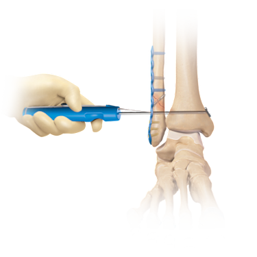 Sistema de implante TightRope<sup>®</sup> XP sindesmosis 