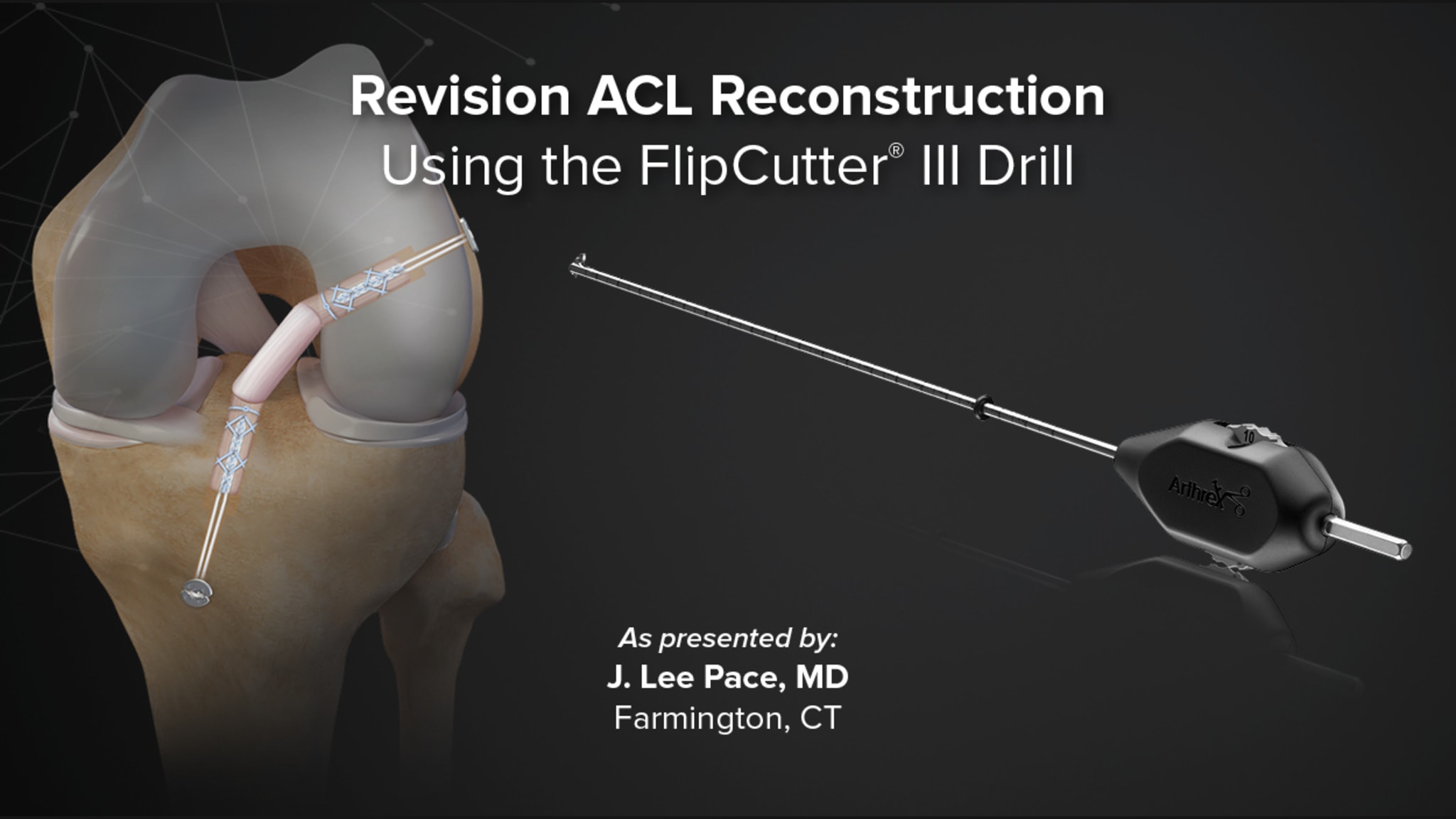Revision ACL Reconstruction Using the FlipCutter® III Drill