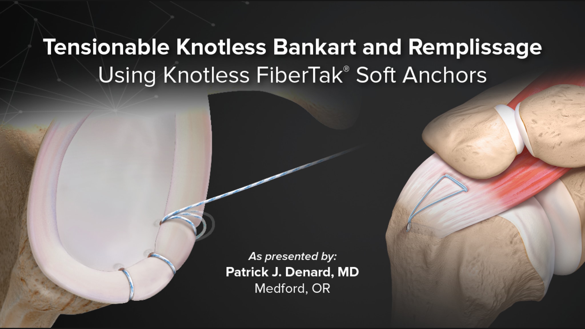 Tensionable Knotless Bankart and Remplissage Using Knotless FiberTak® Soft Anchors
