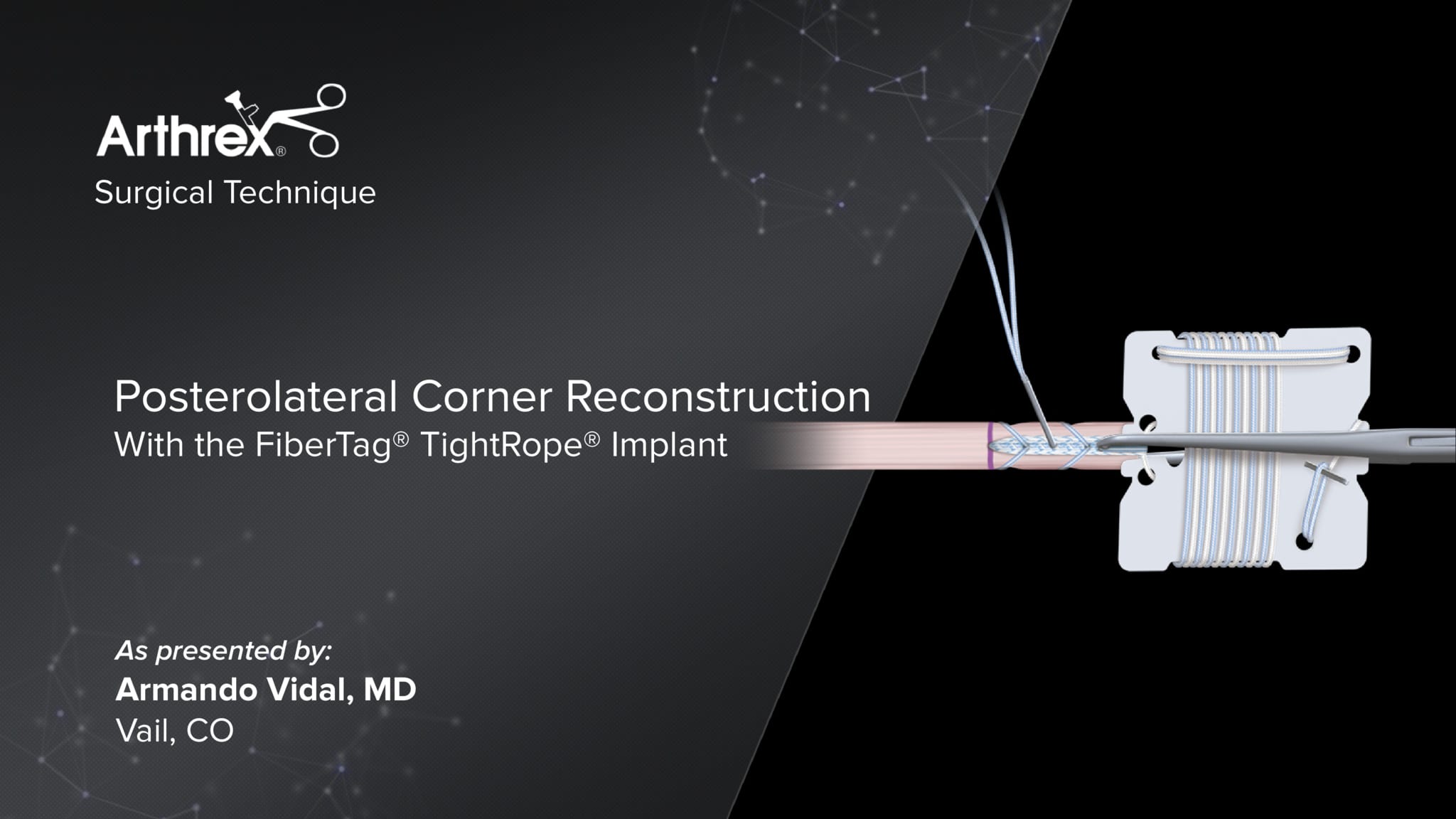 Posterolateral Corner Reconstruction With the FiberTag® TightRope® Implant