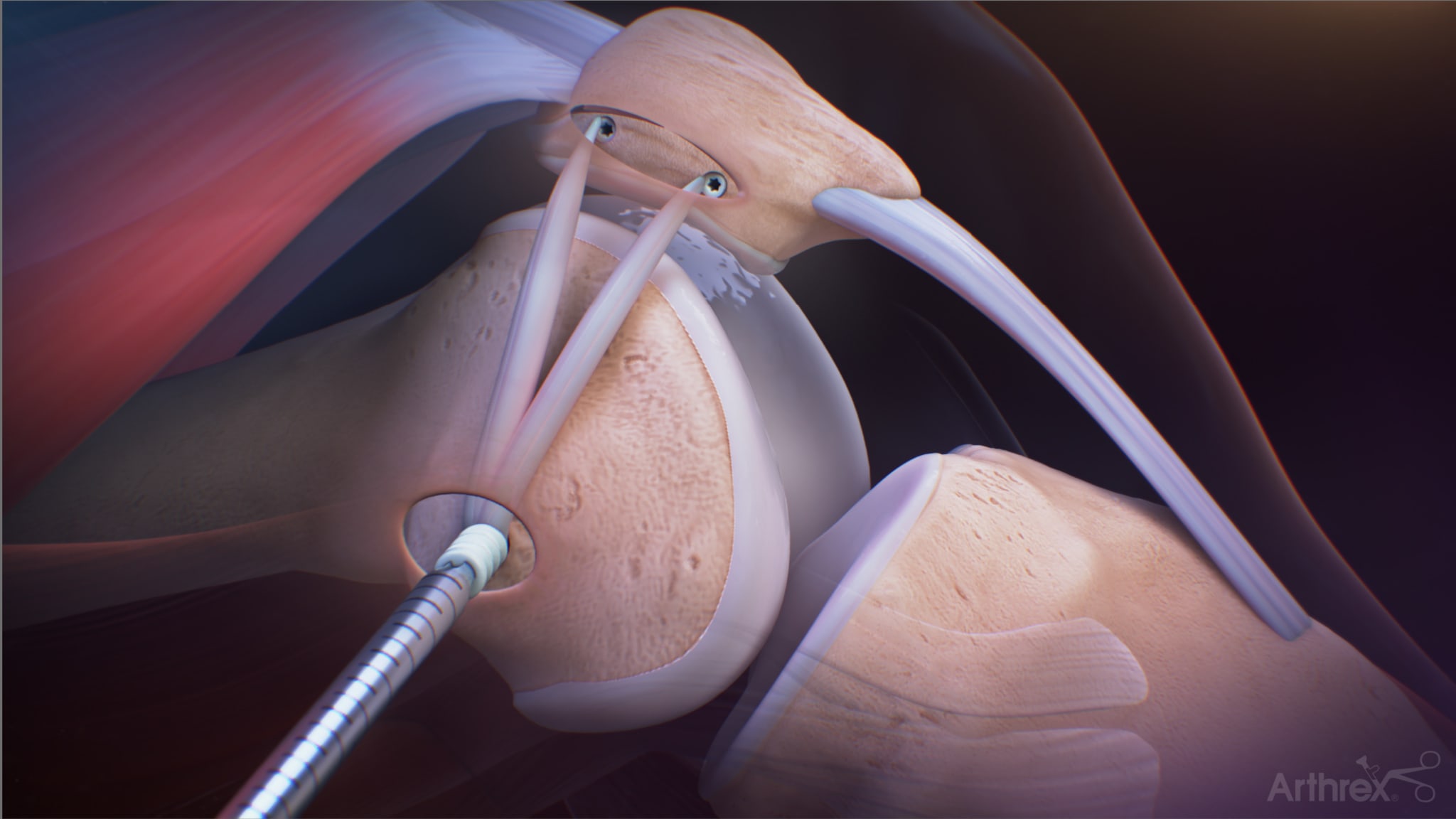 Dr. Sherman - MPFL Reconstruction Using the Infinity™ Femoral Button and  Y-Knot® PRO Flex - Patellar Instability - CONMED VIDEO GALLERY