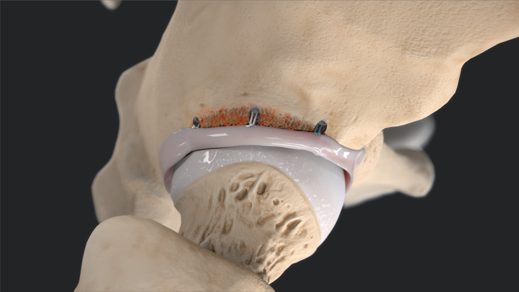Hip Labral Reconstruction