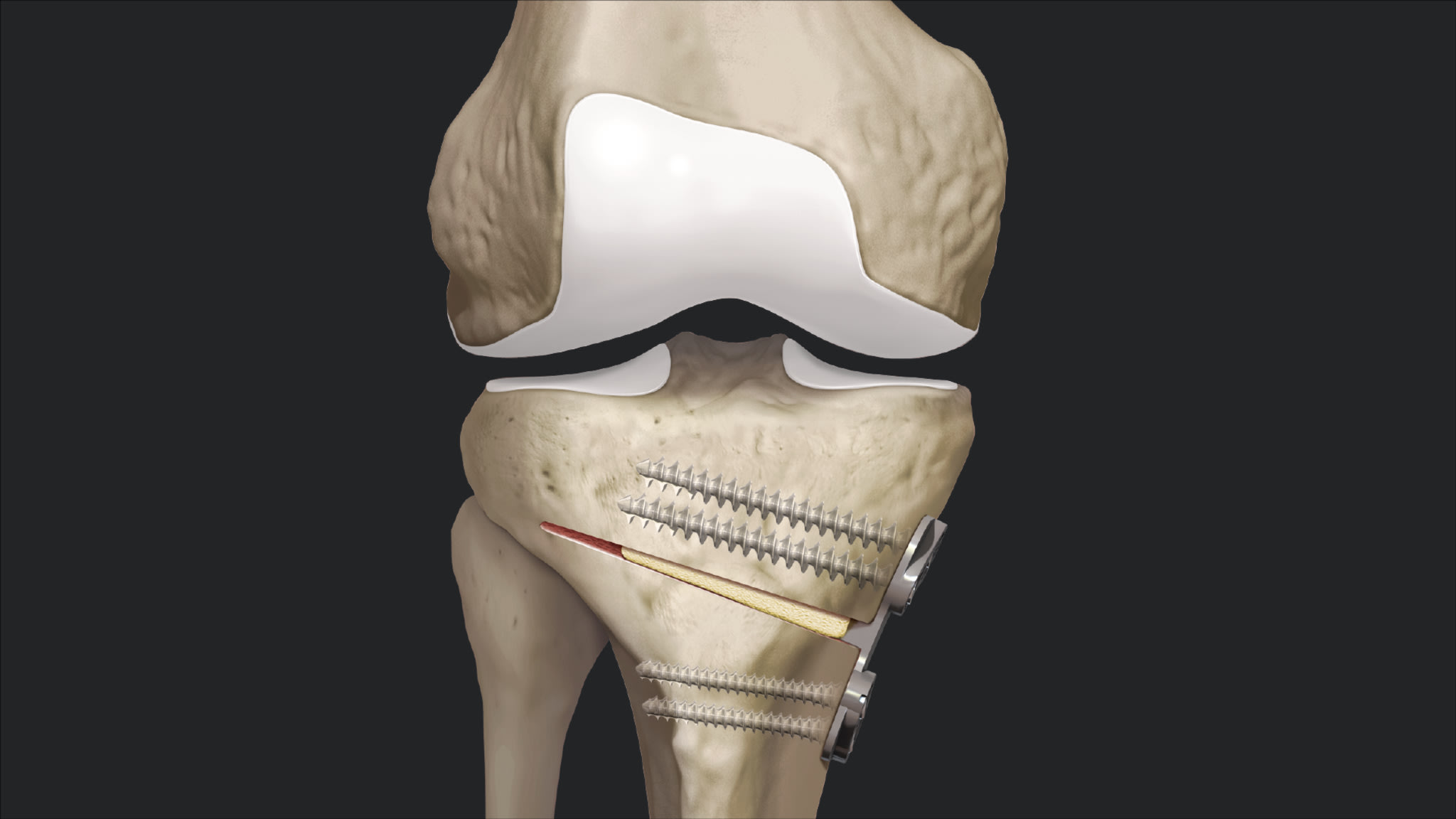 High Tibial Osteotomy Using Tibial Opening Wedge Osteotomy Plates