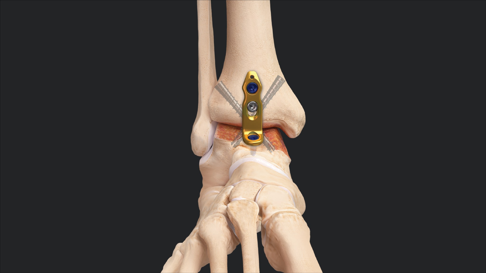 Plantar-Flexed Ankle Fusion Revision Using the Minimally Invasive Ankle Fusion Plate