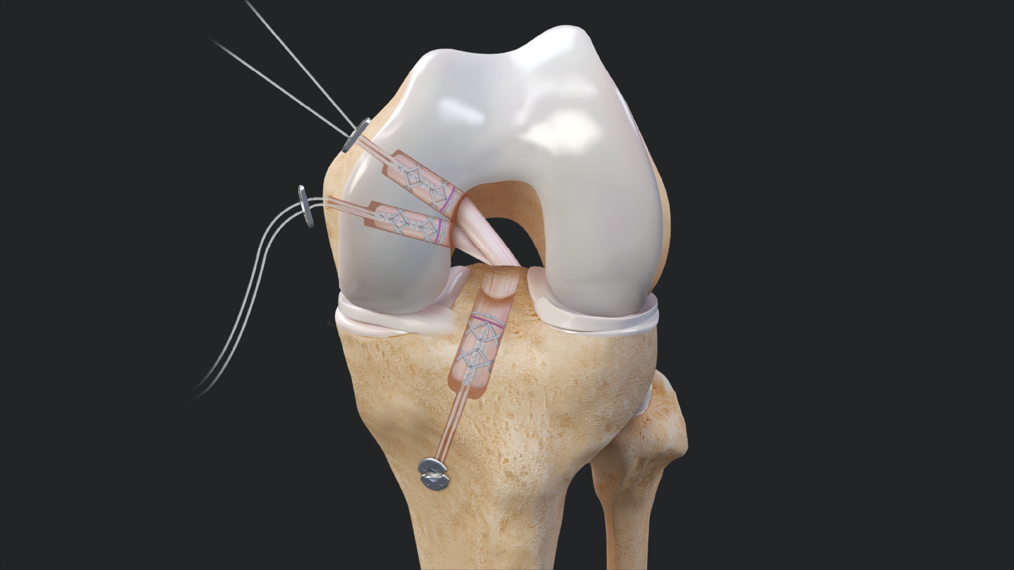 Double-Bundle PCLR Using All-Soft-Tissue Achilles Graft Prepared With FiberTag® TightRope® Implants