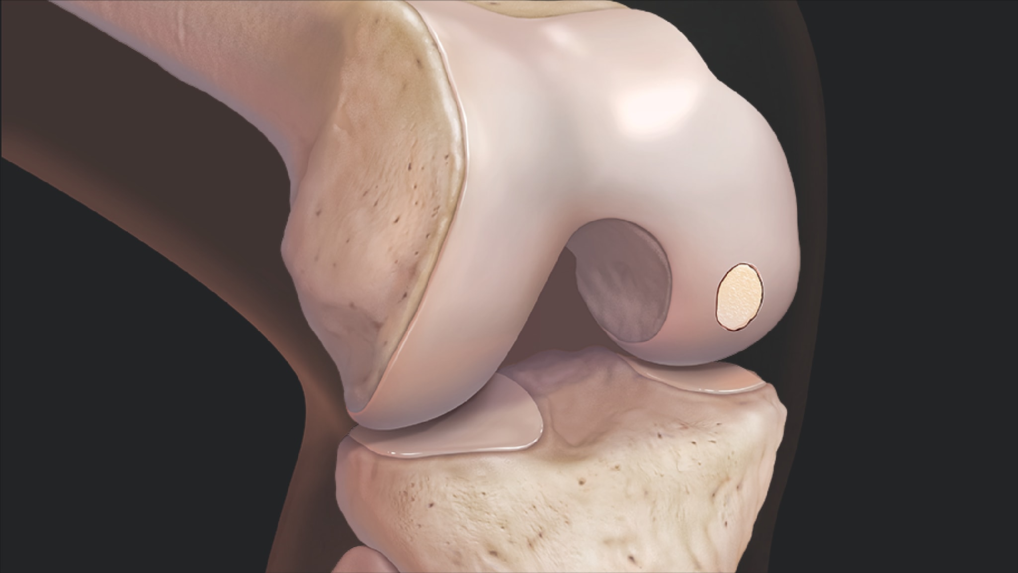 Treatment of Cartilage Defects in the Knee Using BioCartilage® Allograft