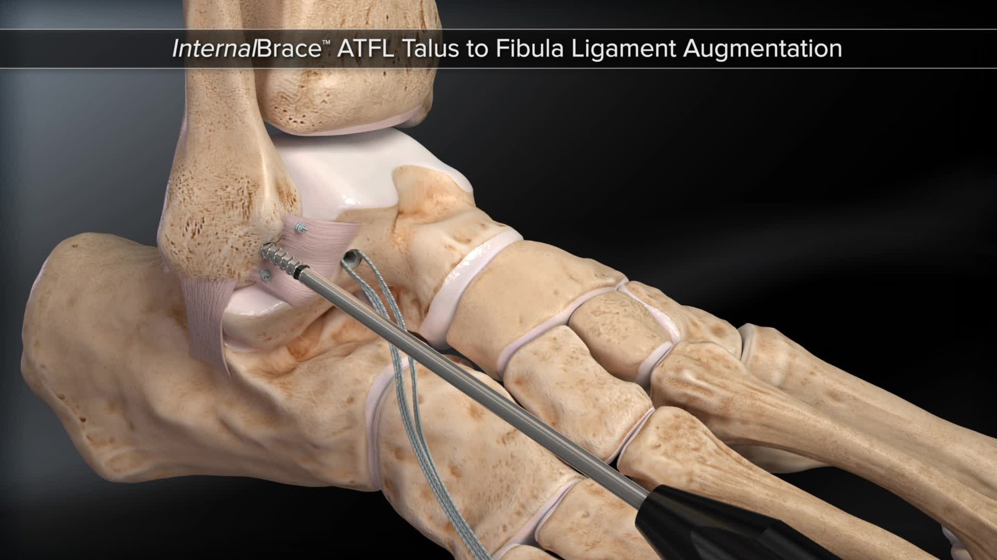 InternalBrace™ ATFL Talus to Fibula Ligament Augmentation