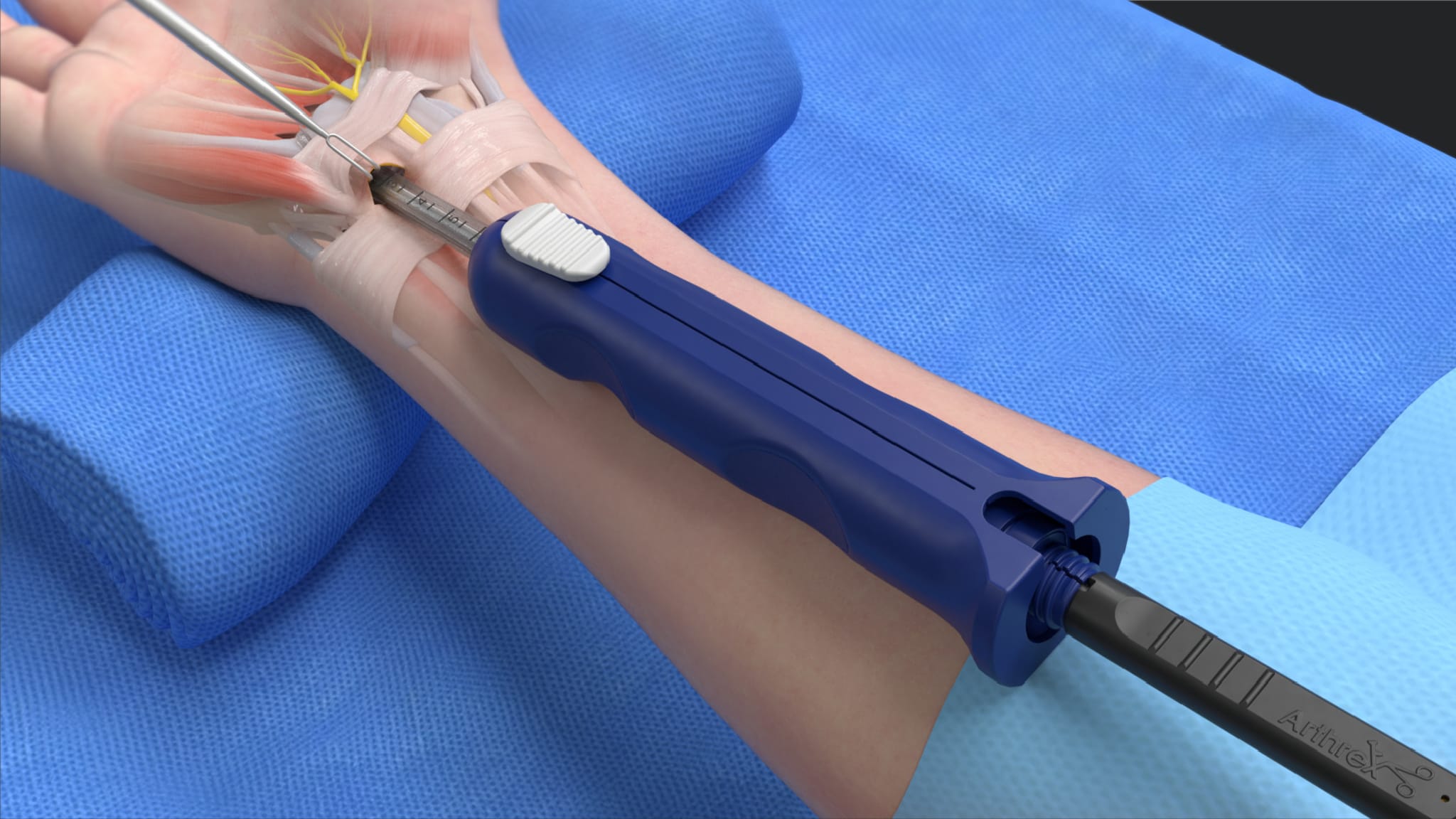 NanoScopic™ Release System for Endoscopic Carpal Tunnel Release