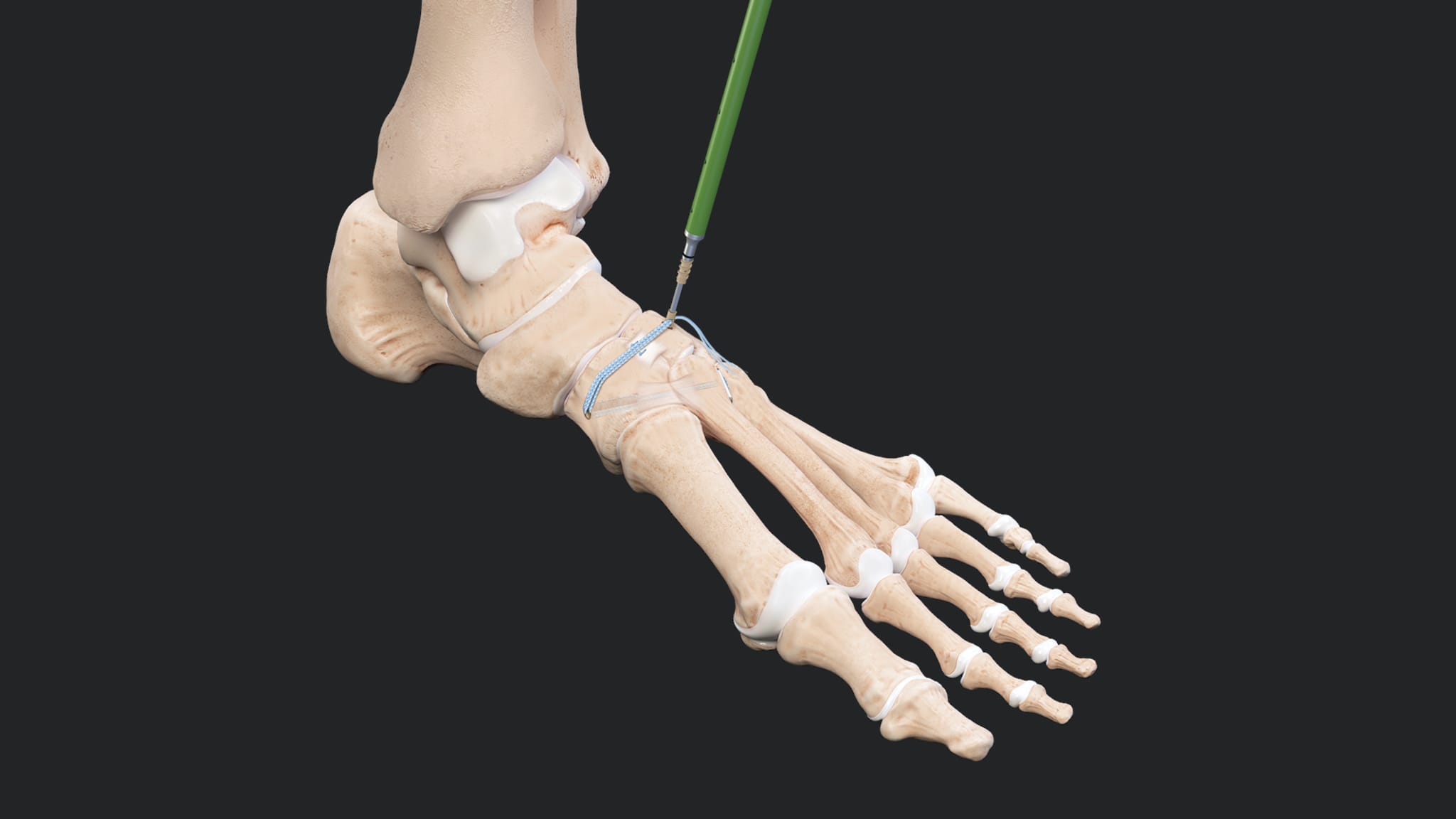 Lisfranc Repair With the InternalBrace™ Technique: Indications, Rationale, and Outcomes