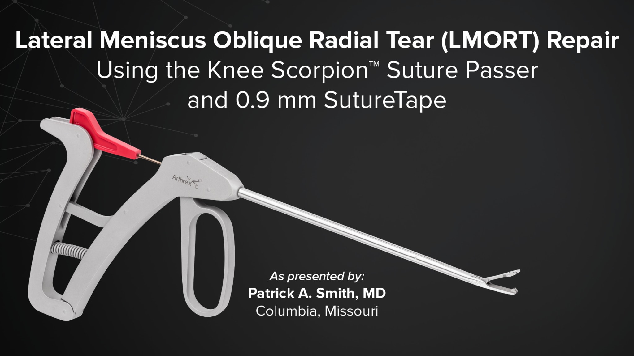 Lateral Meniscus Oblique Radial Tear (LMORT) Repair Using the Knee Scorpion™ Suture Passer and 0.9 mm SutureTape