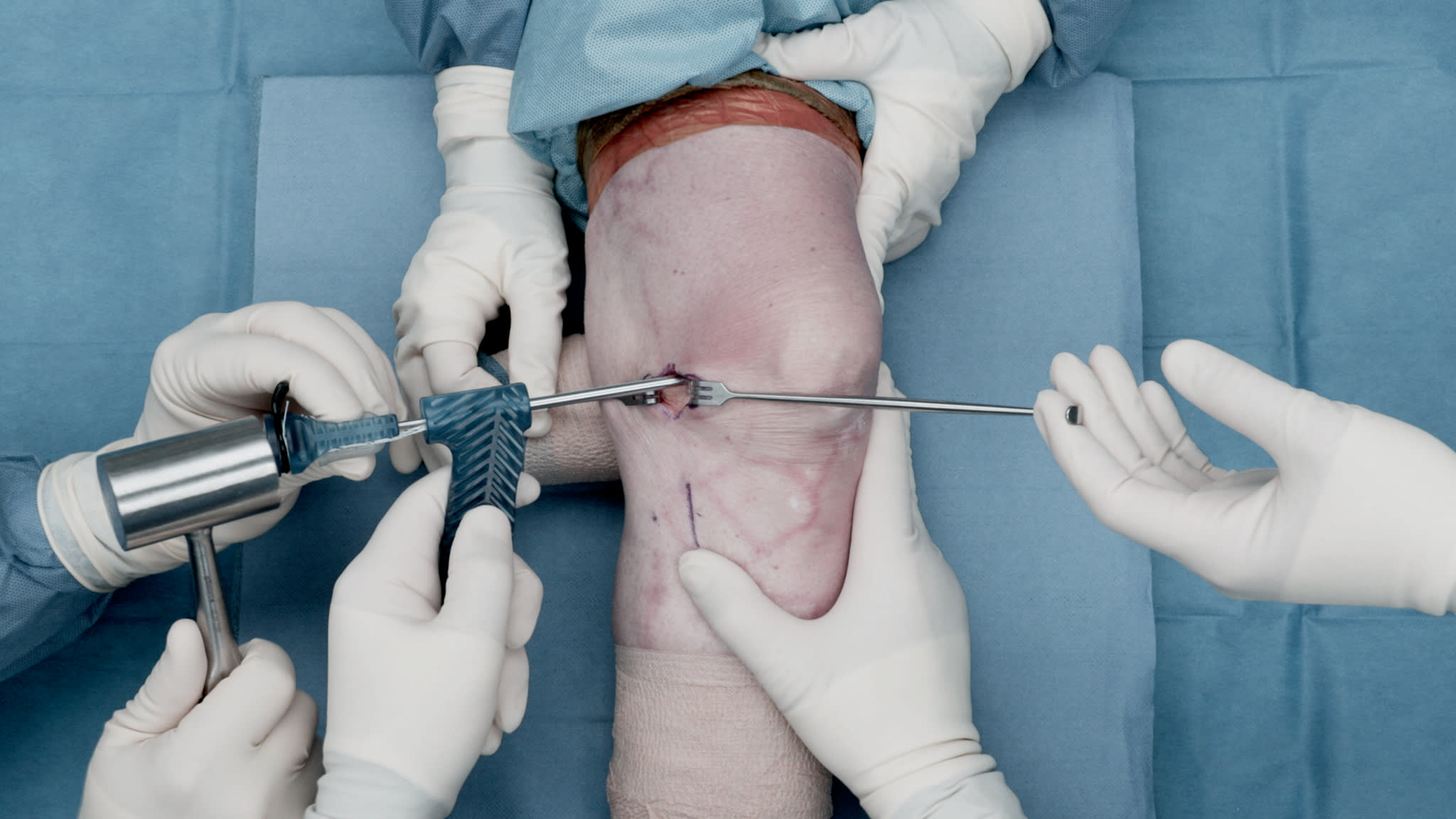 Proximal MCL Repair Using Knee FiberTak® Anchors and the <i>Internal</i>Brace™ Technique