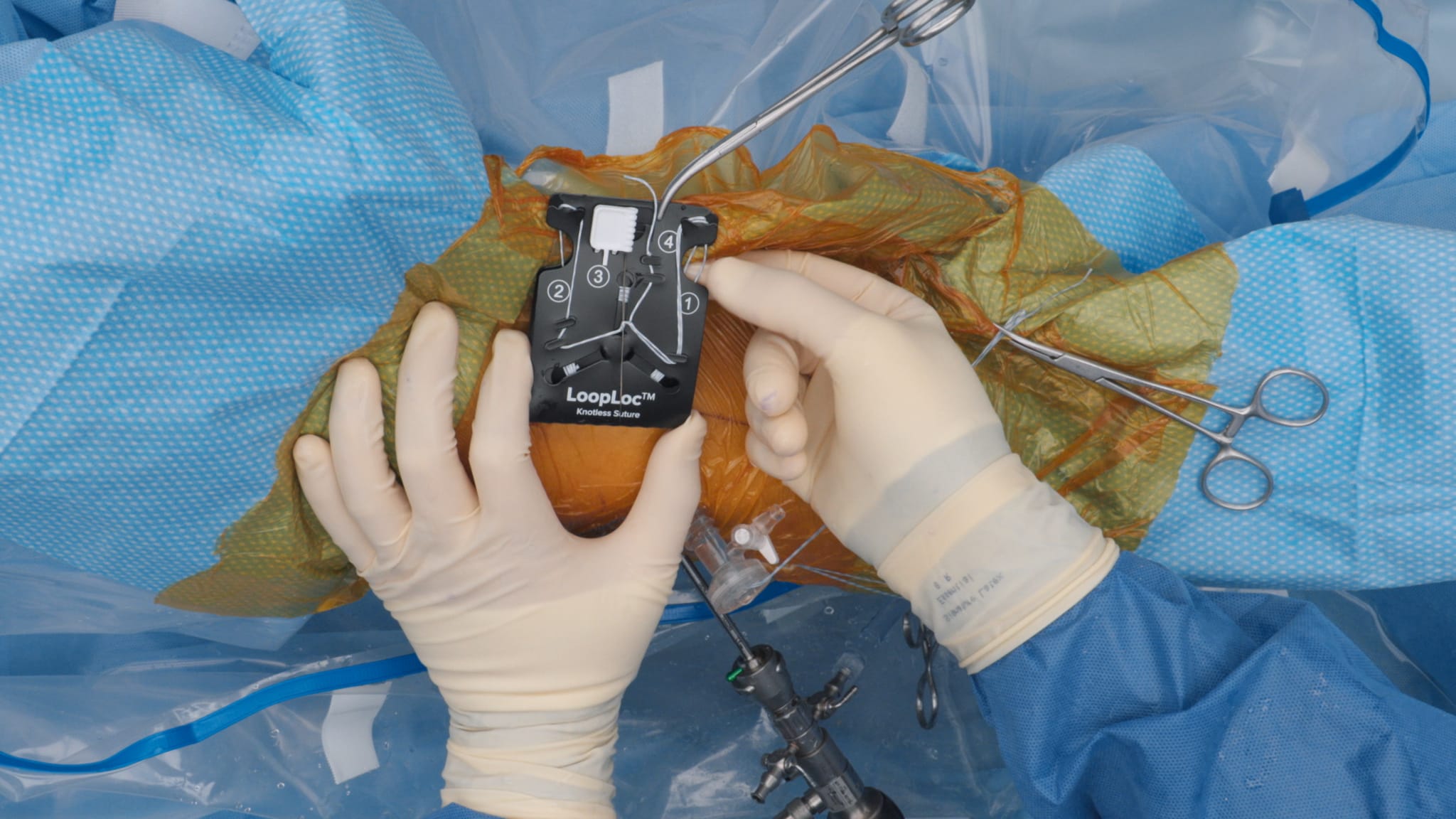 Capsular Closure Surgical Technique Using the LoopLoc™ Knotless Implant CapsuleStitch™ Suture Passer