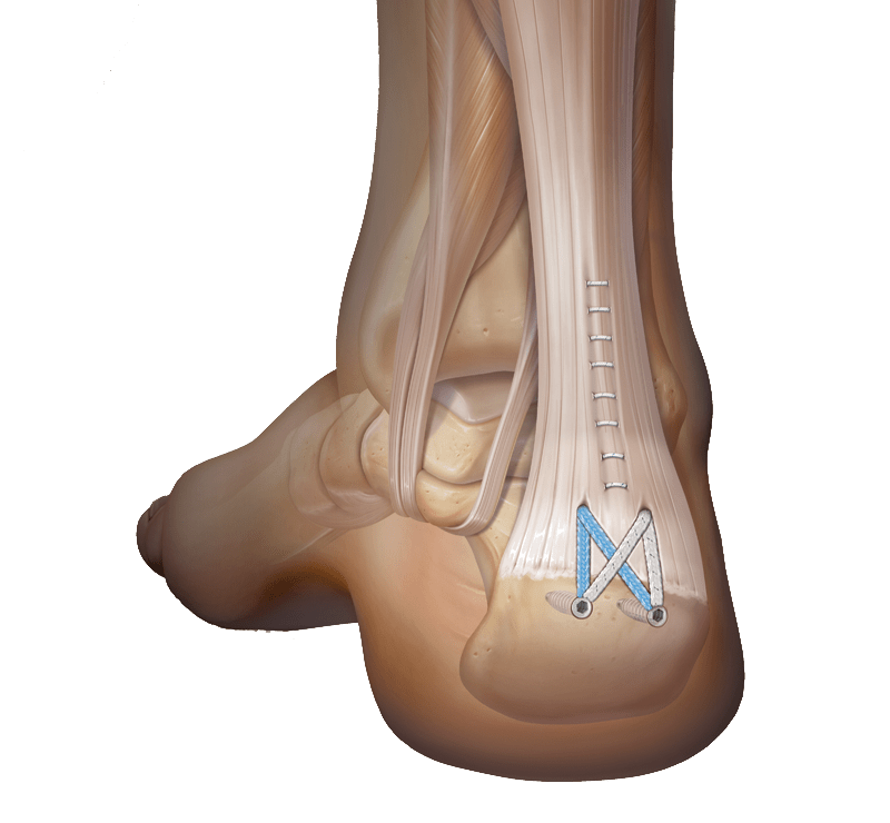 Fijación del tendón para tendinopatía en la inserción del tendón de Aquiles
