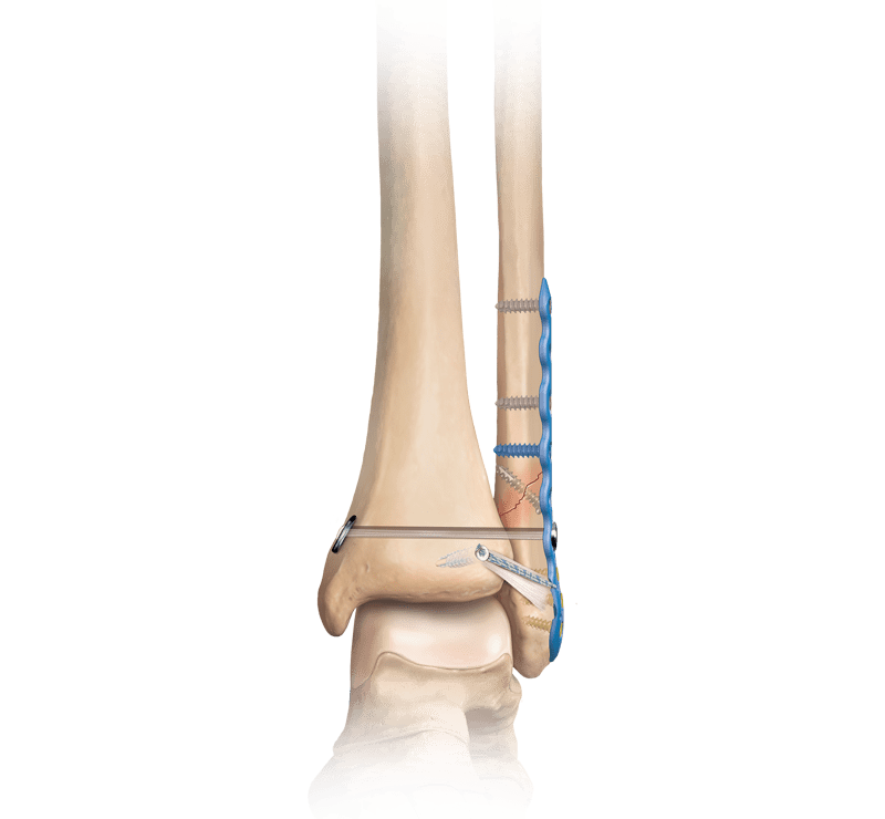 Internal Fixation of Ankle Fractures