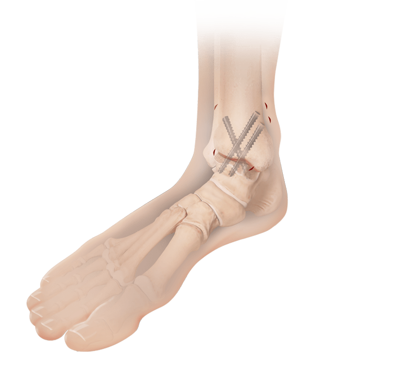 Fusão artroscópica do tornozelo