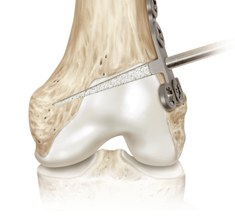 Bone Void Filling