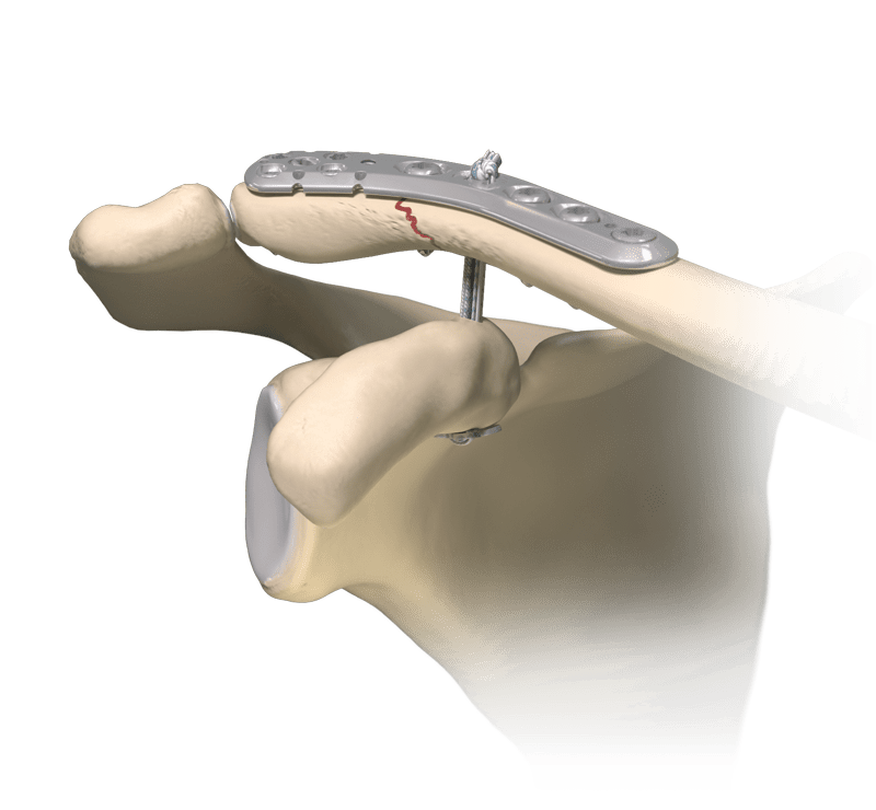 Clavicle Fracture Implants
