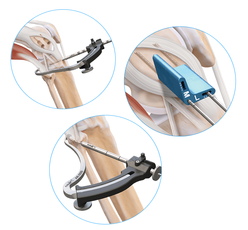Anatomic Collateral Ligament Reconstruction