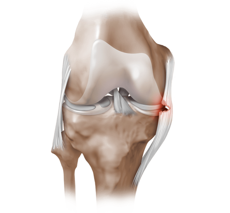 Collateral Ligament Tear