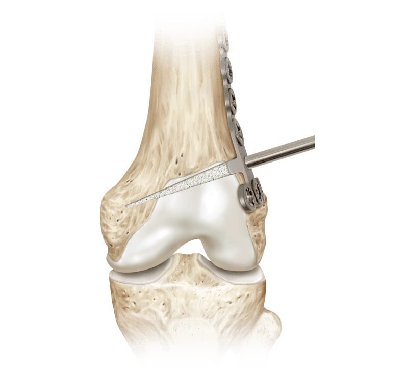 Distal Femoral Osteotomy 