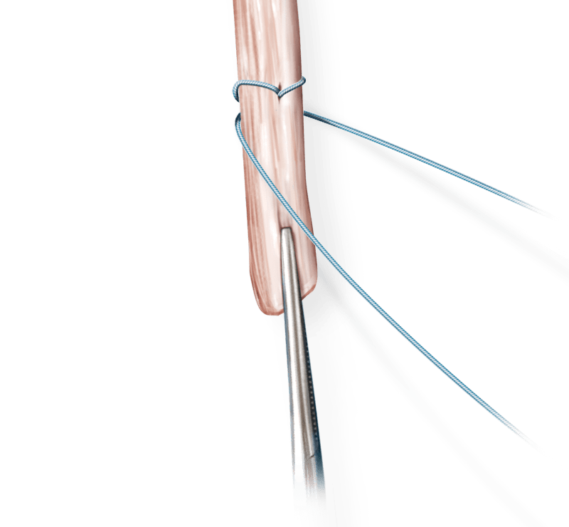 Reparo do flexor/extensor com sutura FiberWire<sup>®</sup>