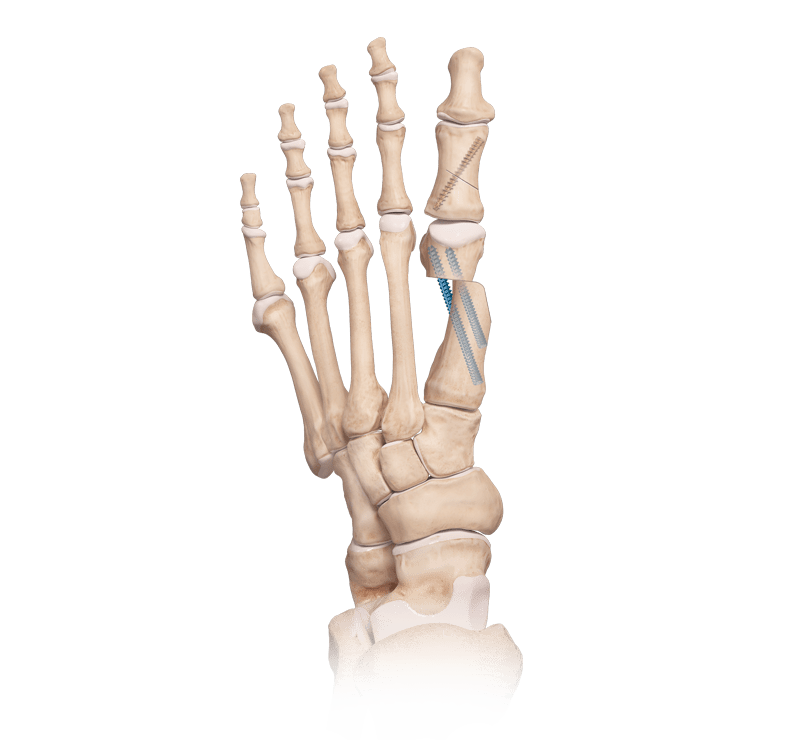 Osteotomie des ersten Mittelfußknochens