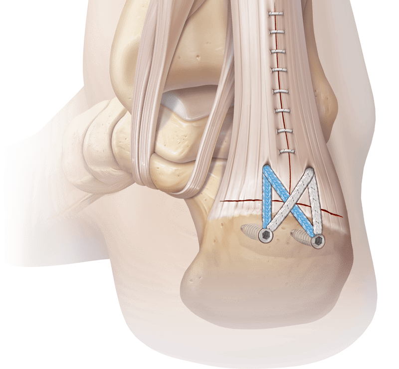 Soft Tissue Fixation Devices