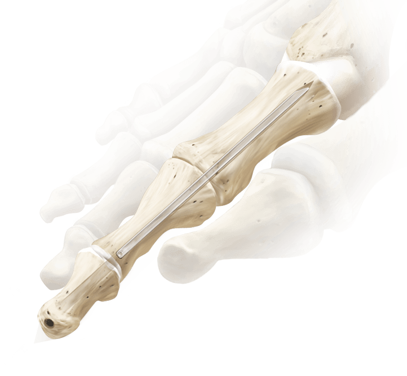 Interphalangeal Joint Fusion