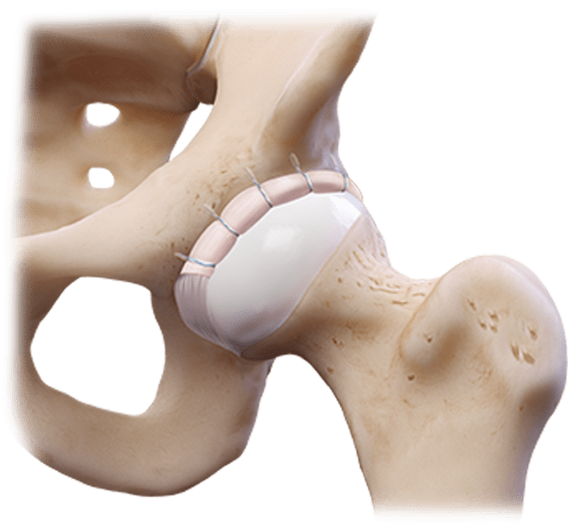 Labral Fixation
