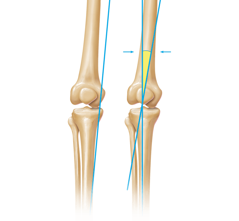Limb Deformity