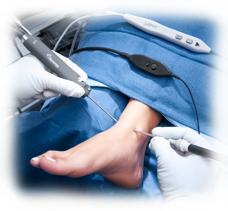 Nano Arthroscopy for Foot and Ankle
