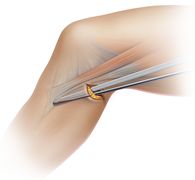 PCL-Hamstring-Transplantatgewinnung und -präparation